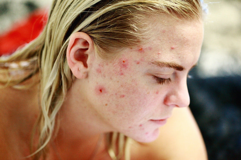 Acne Causes, Prevention and Treatment-TensCare Ltd